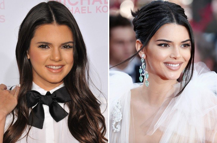 Did Kendall Jenner go under the knife for a secret plastic surgery ...